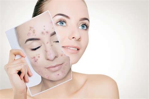 Acne cuidado facial Continuara.org