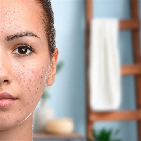Acne manchas ojos Continuara.org